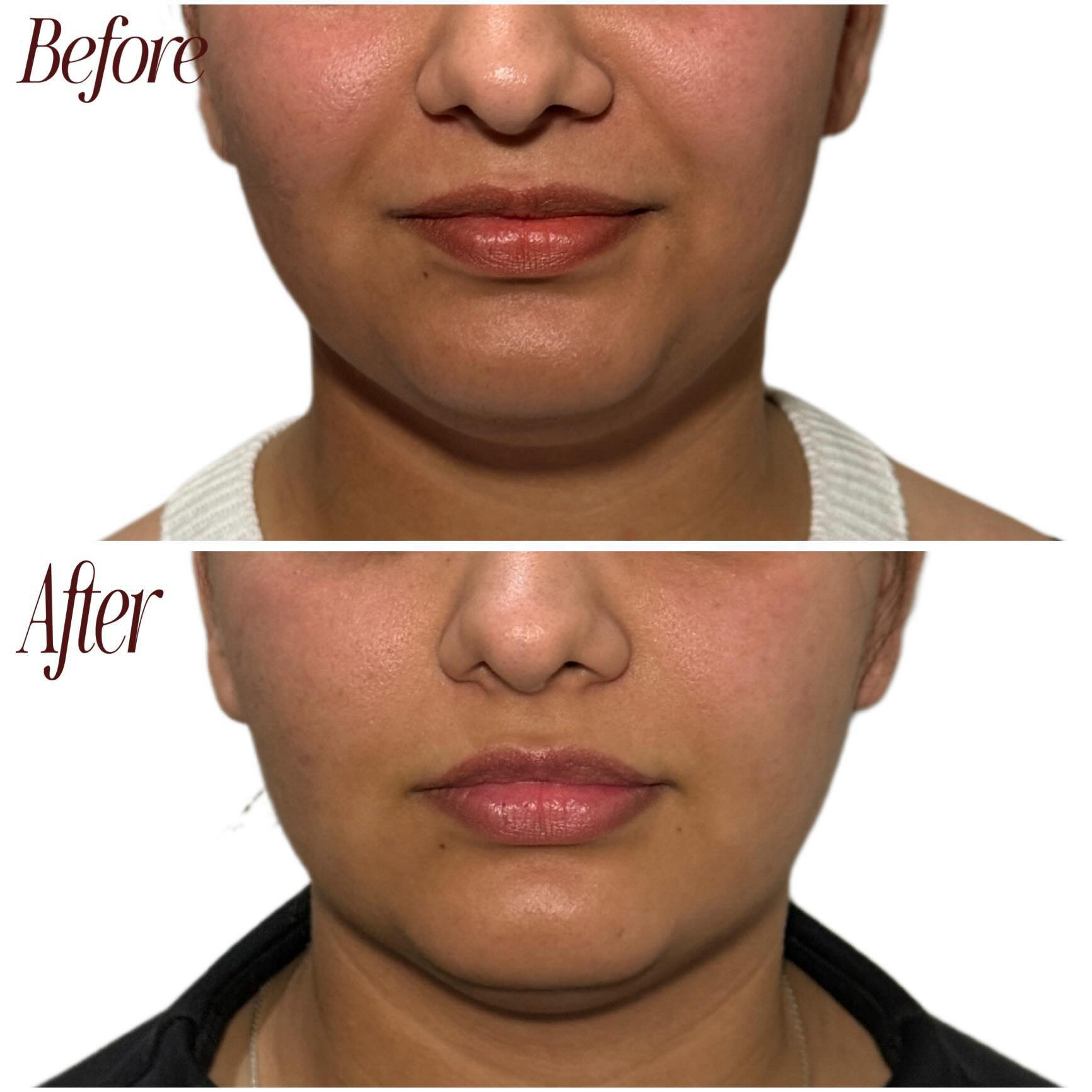 Chin & jaw slimming · 2 of 6 sessions before and after results at El Asilo