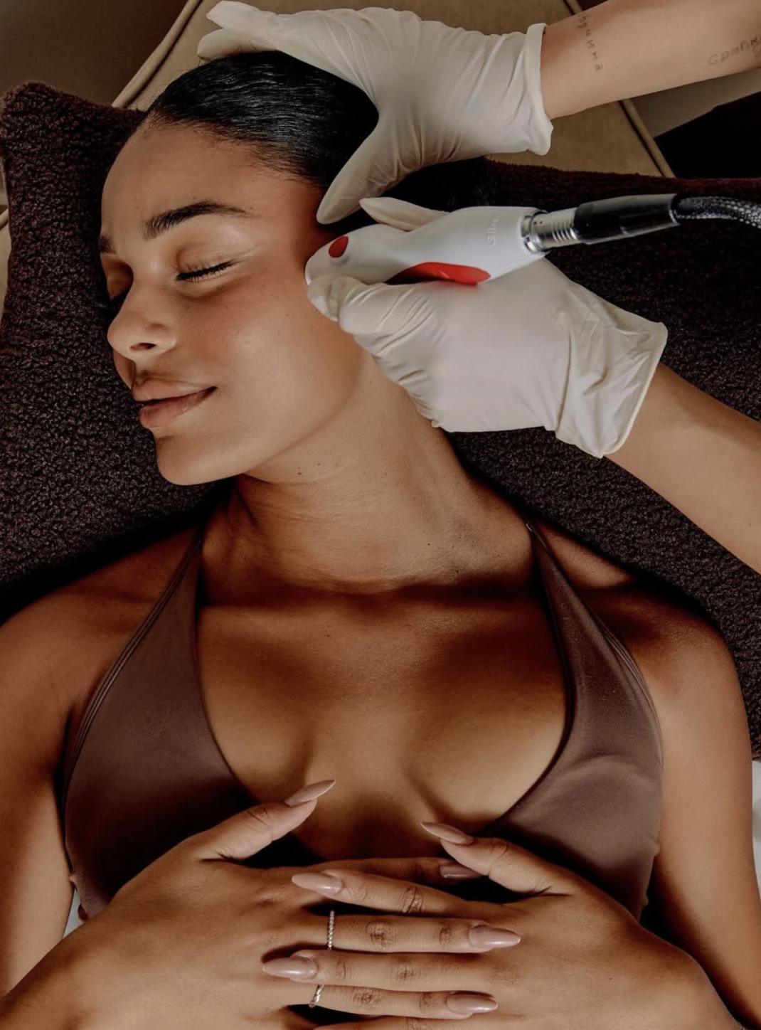 Close-up of an El Asilo treatment using radiofrequency technology