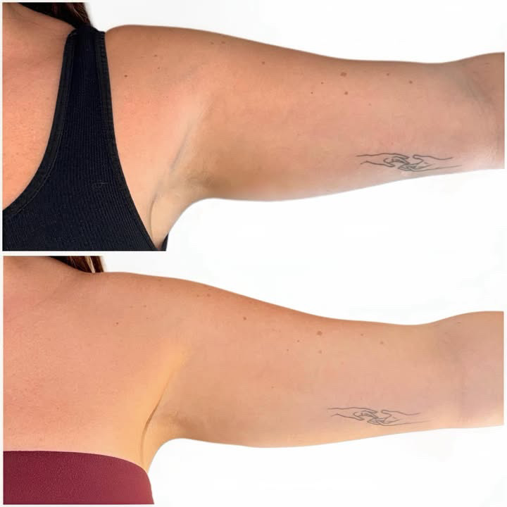 Arm fat reduction & retraction before and after results at El Asilo