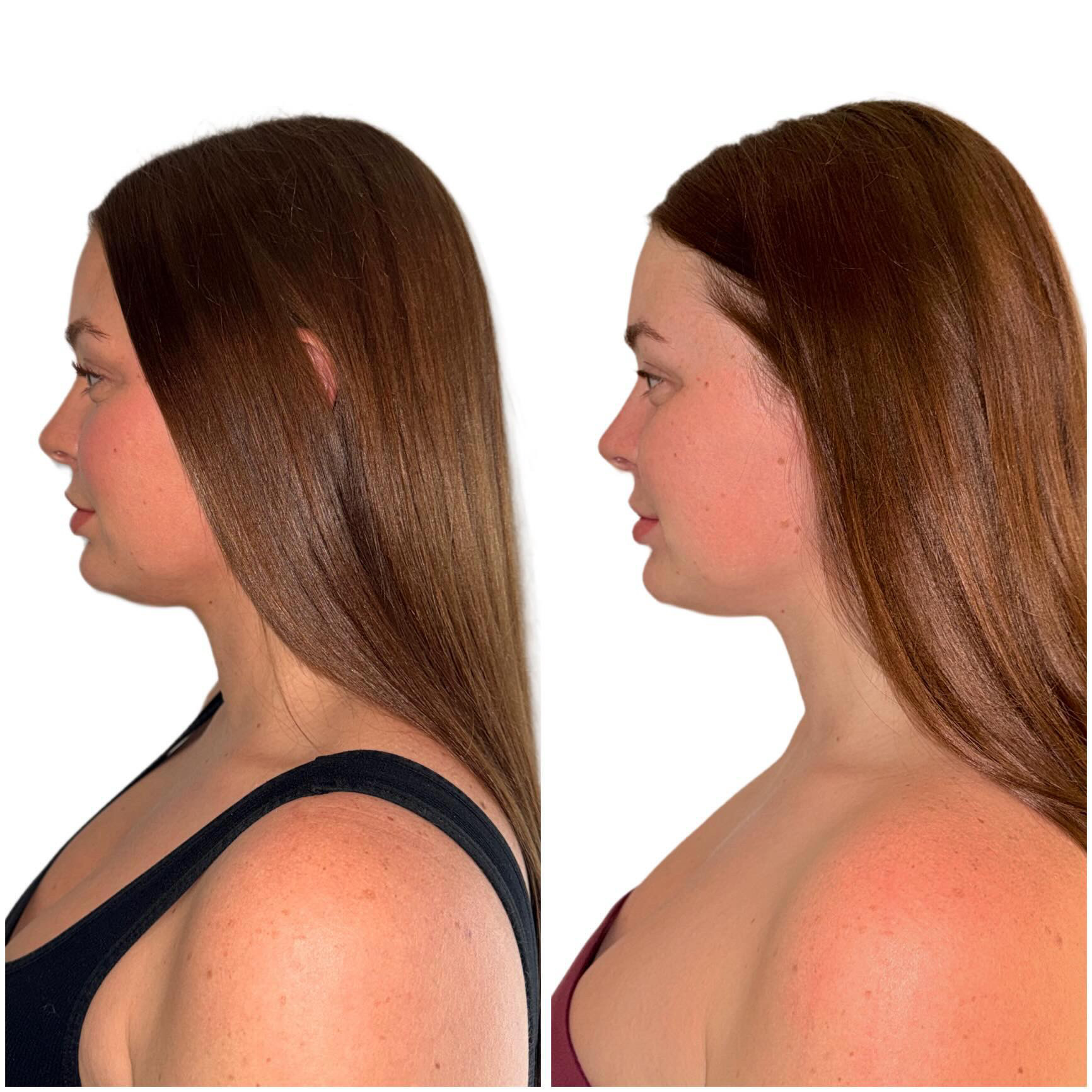 Chin fat reduction & retraction before and after results at El Asilo