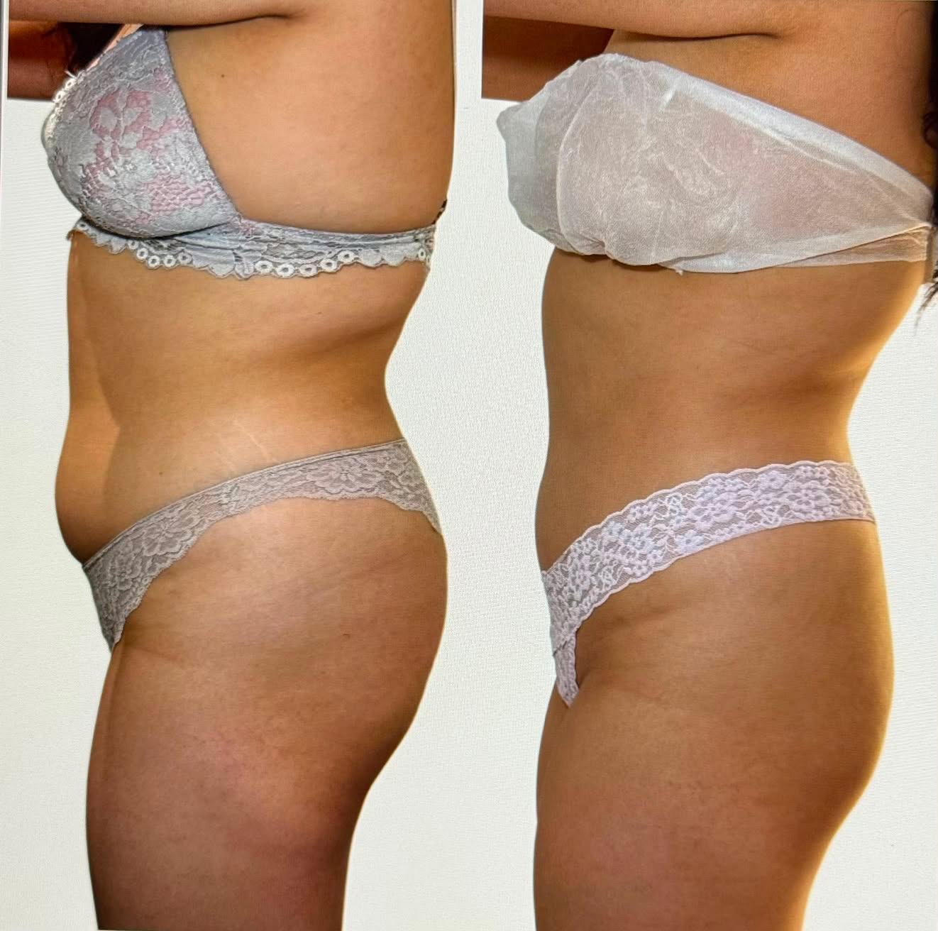 Tummy, love handles & bra fat · 6 of 6 complete before and after results at El Asilo